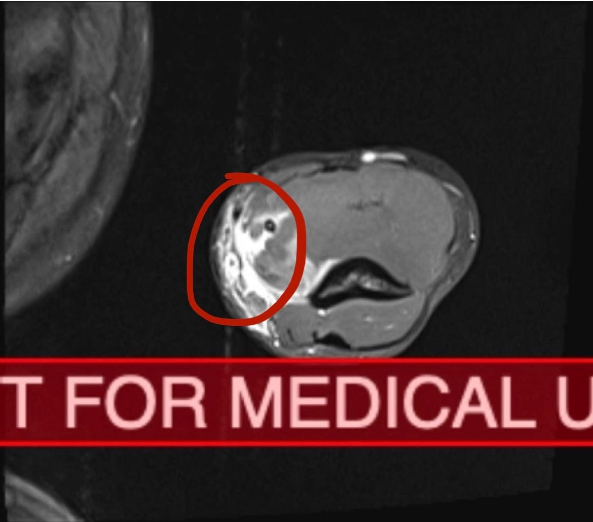closeup of MRI image with injury circled in red